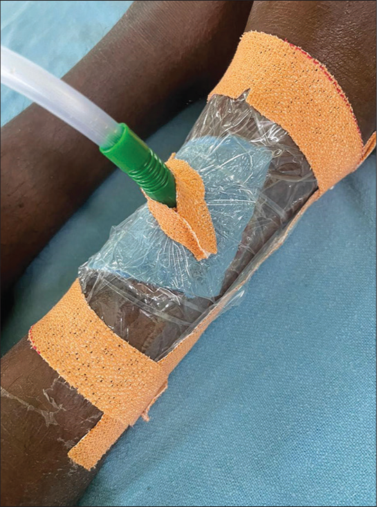 Wound is debrided and the sponge is cut according to wound size using surgical blade. The sponge is maintained in the position using cling film, sealed using dynaplast. The suction tube connected to suction gauze attached in the ward is utilized for creating negative pressure.