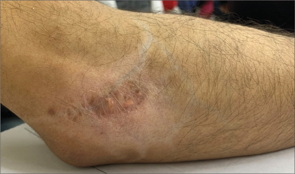 Depigmented patch surrounding a treated keloid on right elbow. The depigmentation has occurred in a stellate fashion, extending along the superficial veins that have become more prominent due to atrophy.