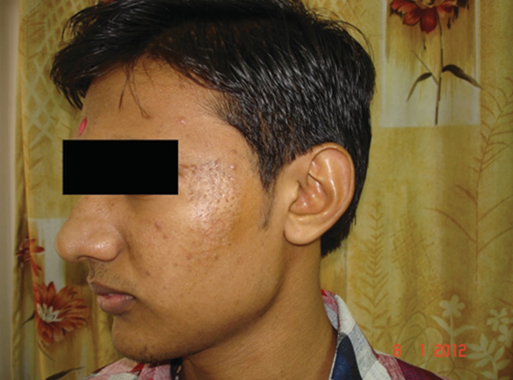 Recipient site showing good uptake and repigmentation post– split thickness skin graft 2 months post-op.