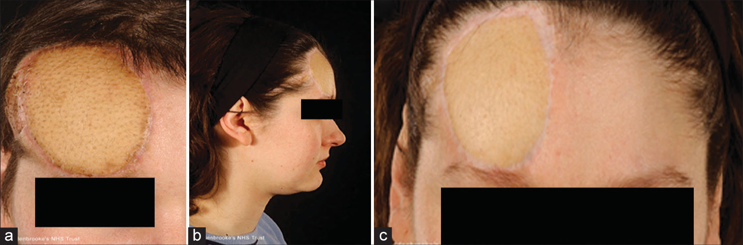 (a) Early postoperative image of the flap prior to revisional surgery. The skin graft is visible lateral to the skin paddle. (b) Following revision to reduce bulk and excise the split thickness skin graft (SSG). Lateral postoperative appearance showing no contour deformity. (c) Magnified view of the flap illustrating the color and texture mismatch.