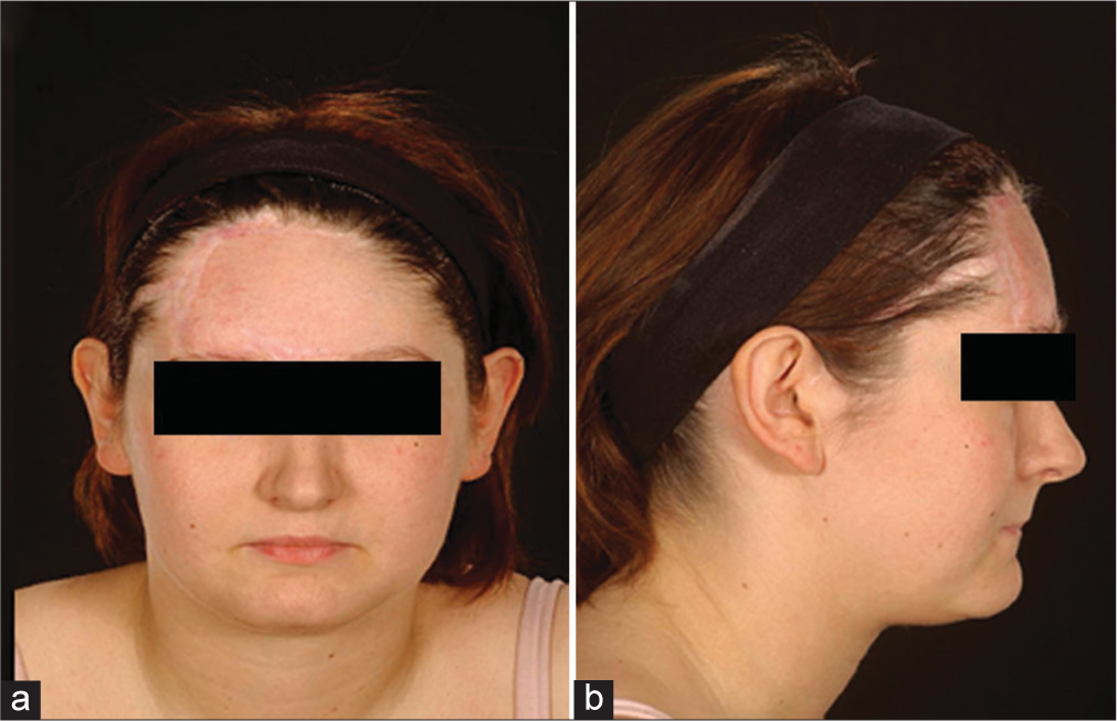 (a) At 6-month follow-up following excision of the anterolateral thigh (ALT) and inset of expanded contralateral skin of the forehead. There is an improved color and texture match. (b) A lateral view illustrating good contour with a preserved hairline and brow position.