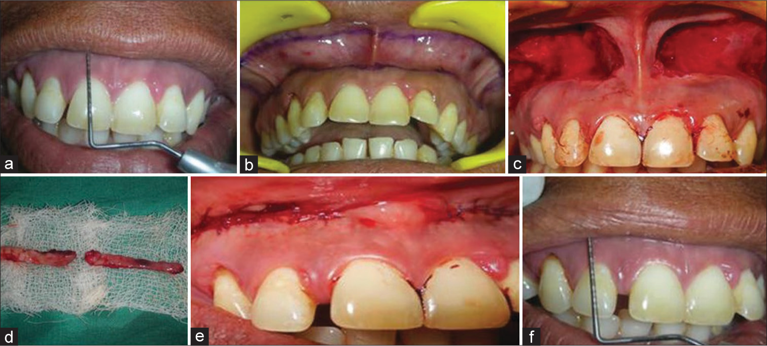 Surgical procedure for Group A. (a) Preoperative measurements. (b) Outline marked. (c) Dissection of mucosa. (d) Excised mucosa. (e) Sutures placed. (f) Postoperative measurements.