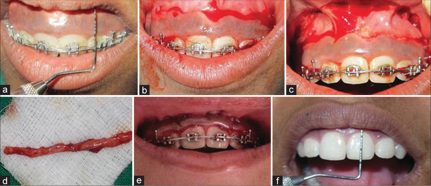 Surgical procedure for Group B. (a) Preoperative measurements. (b) Incisions placed. (c) Dissection of mucosa. (d) Excised mucosa. (e) Sutures placed. (f) Postoperative measurements.