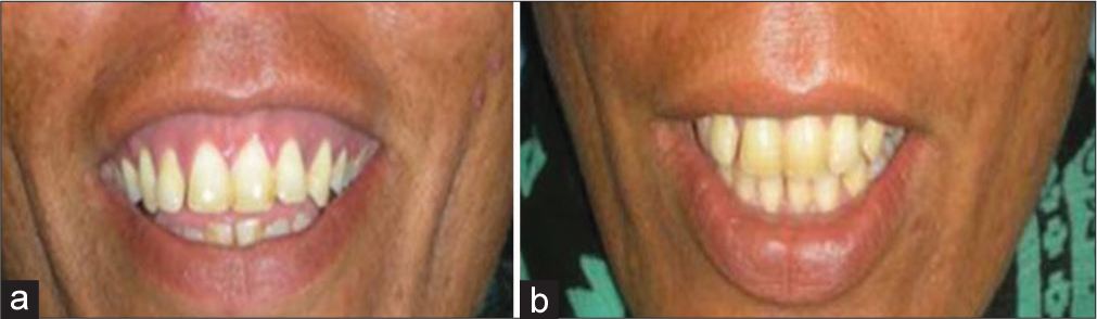 Postoperative view after 2 years for Group A. (a) Preoperative view. (b) Postoperative view after 2 years.