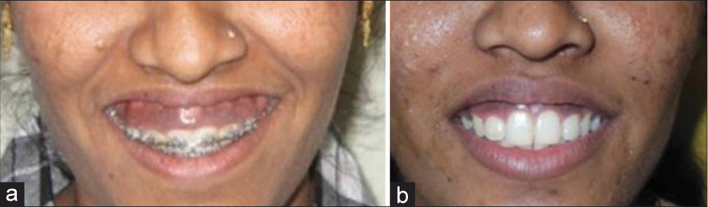 Postoperative view after 2 years for Group B. (a) Preoperative view. (b) Postoperative view after 2 years.