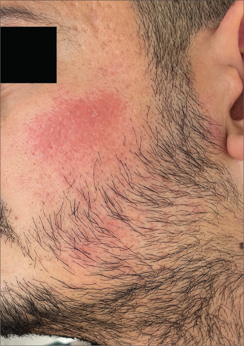 Persistent erythematous plaque post dermaroller over the left cheek.