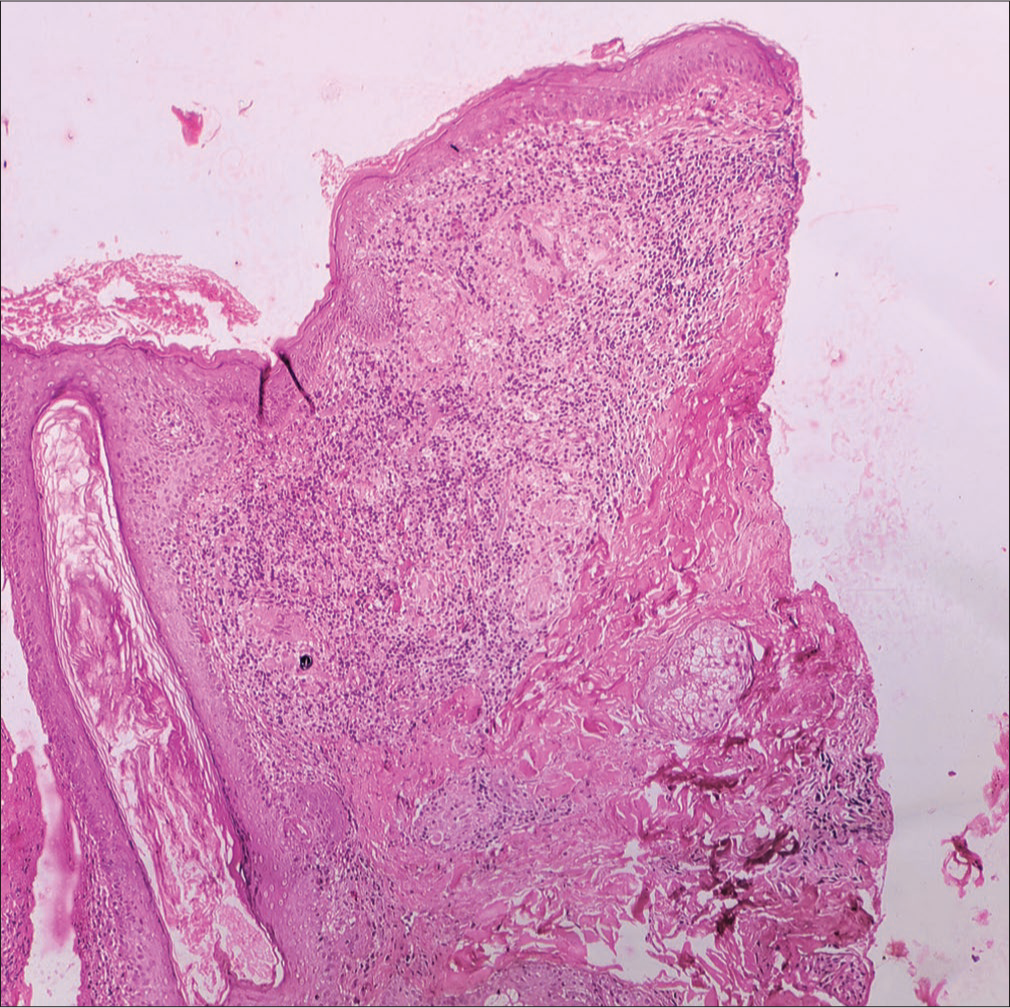 (H & E 100×) Histopathology revealed multiple ill-formed granulomas with aggregates of foamy histiocytes in the dermis. H & E = hematoxylin and eosin.