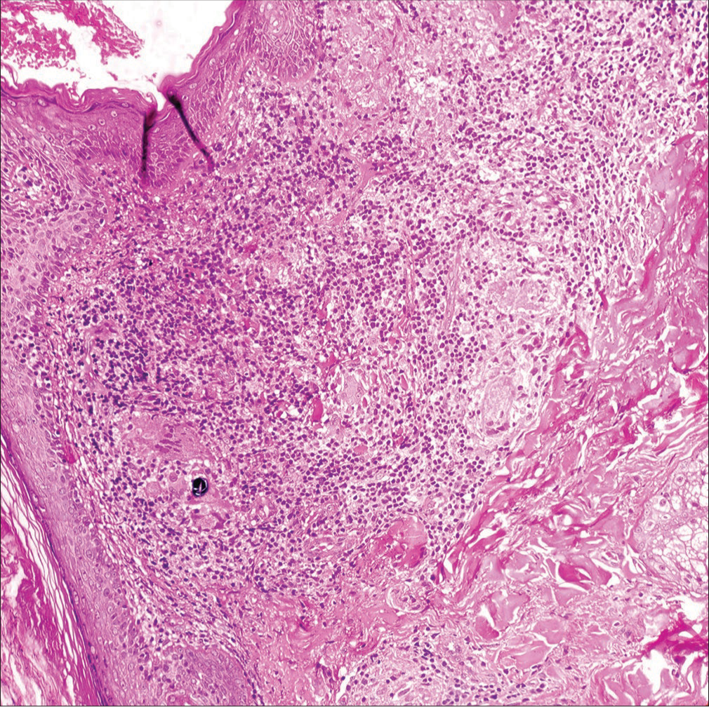 (H & E 200×) Histopathology revealed multiple ill-formed granulomas with aggregates of foamy histiocytes in the dermis. Multiple foreign-body giant cells were visible with two foreign-body giant cells showing intracytoplasmic refractile brownish foreign bodies. H & E = hematoxylin and eosin.