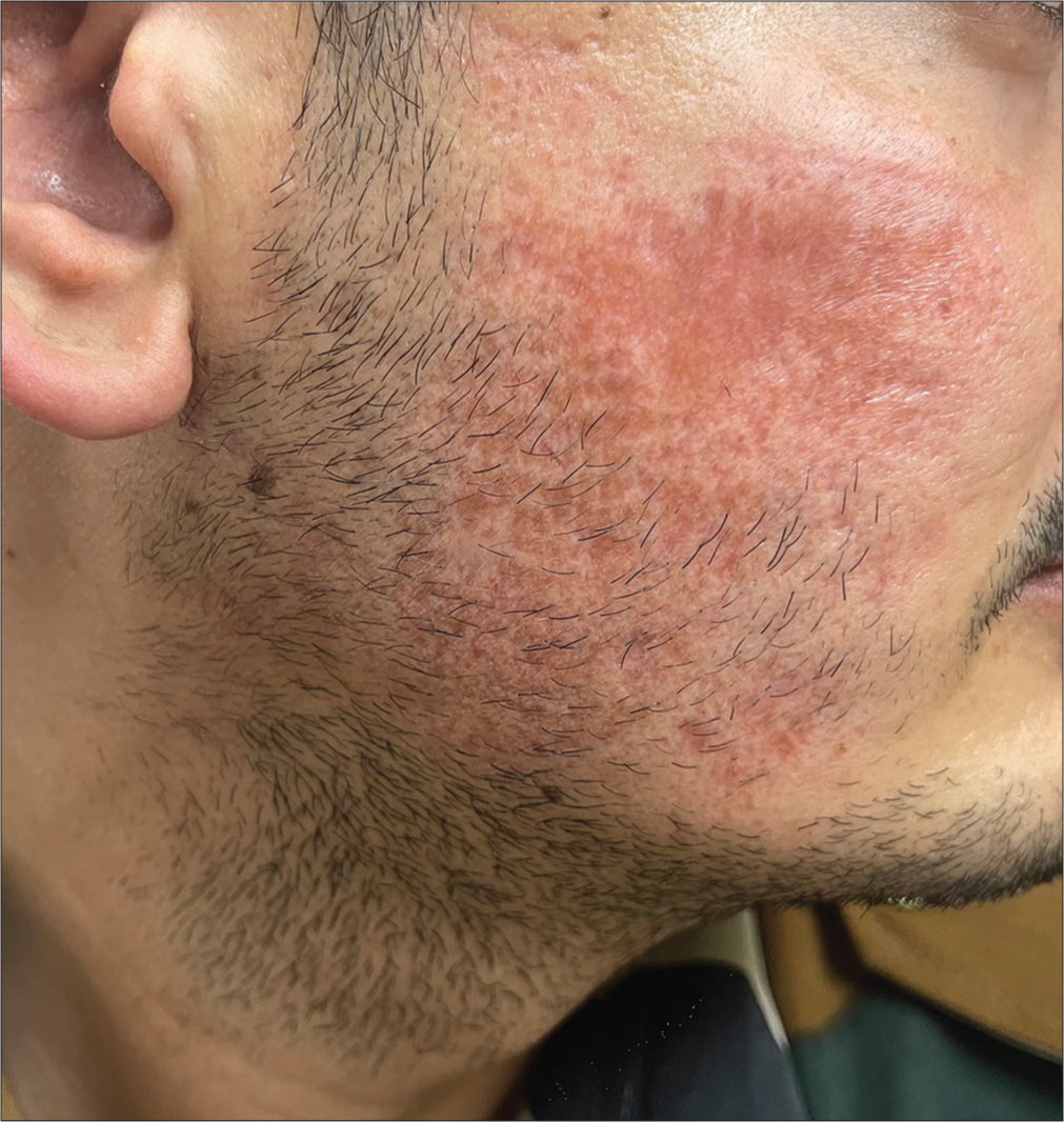 Marked regression in induration of erythematous plaque over the right cheek after 12 weeks of treatment.