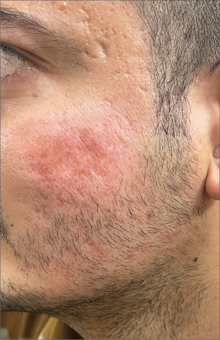 Marked regression in induration of erythematous plaque over the left cheek after 12 weeks of treatment.