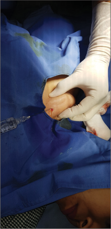 Tumescent anesthesia infiltrated into lipoma with a 20G spinal needle.