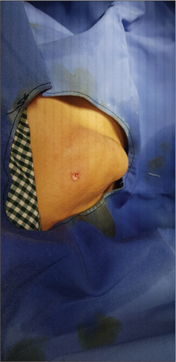 Lipoma tumesced post infiltration.