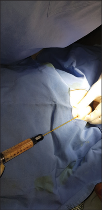 Aspiration of fat from lipoma with a 10 Luer lock syringe.