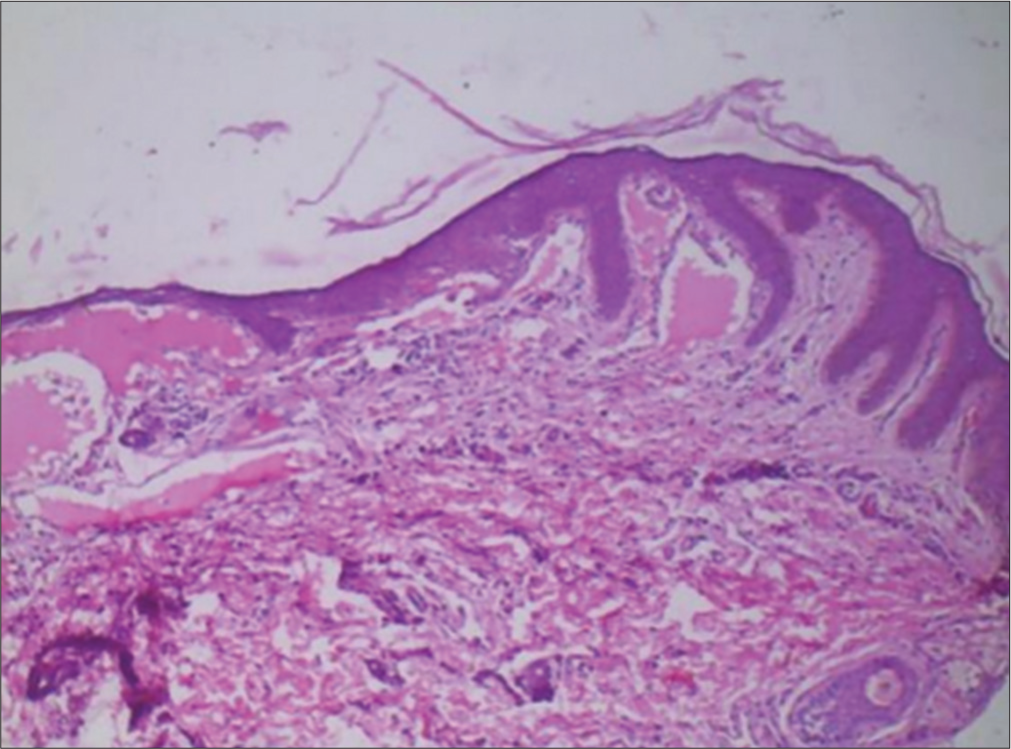 Histopathology showing dilated lymphatic channels filled eosinophilic proteinaceous collection seen within widened dermal papillae (H&E ×10). H&E: Hematoxylin and eosin.