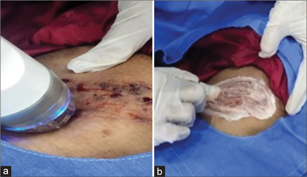 Treatment (a) Microneedle radiofrequency (MNRF). (b) Application of sirolimus cream during the procedure.