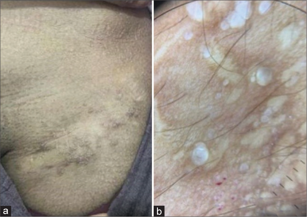 Posttreatment 9 months (a) showing resolution of lesions and (b) dermoscopy showing resolution of blood-filled lacunae.