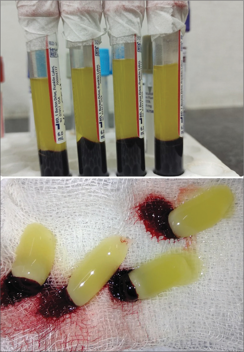 Platelet-rich fibrin with red blood cell (RBC) tail. This platelet-rich fibrin (PRF) is placed on the wound and dressing is done.