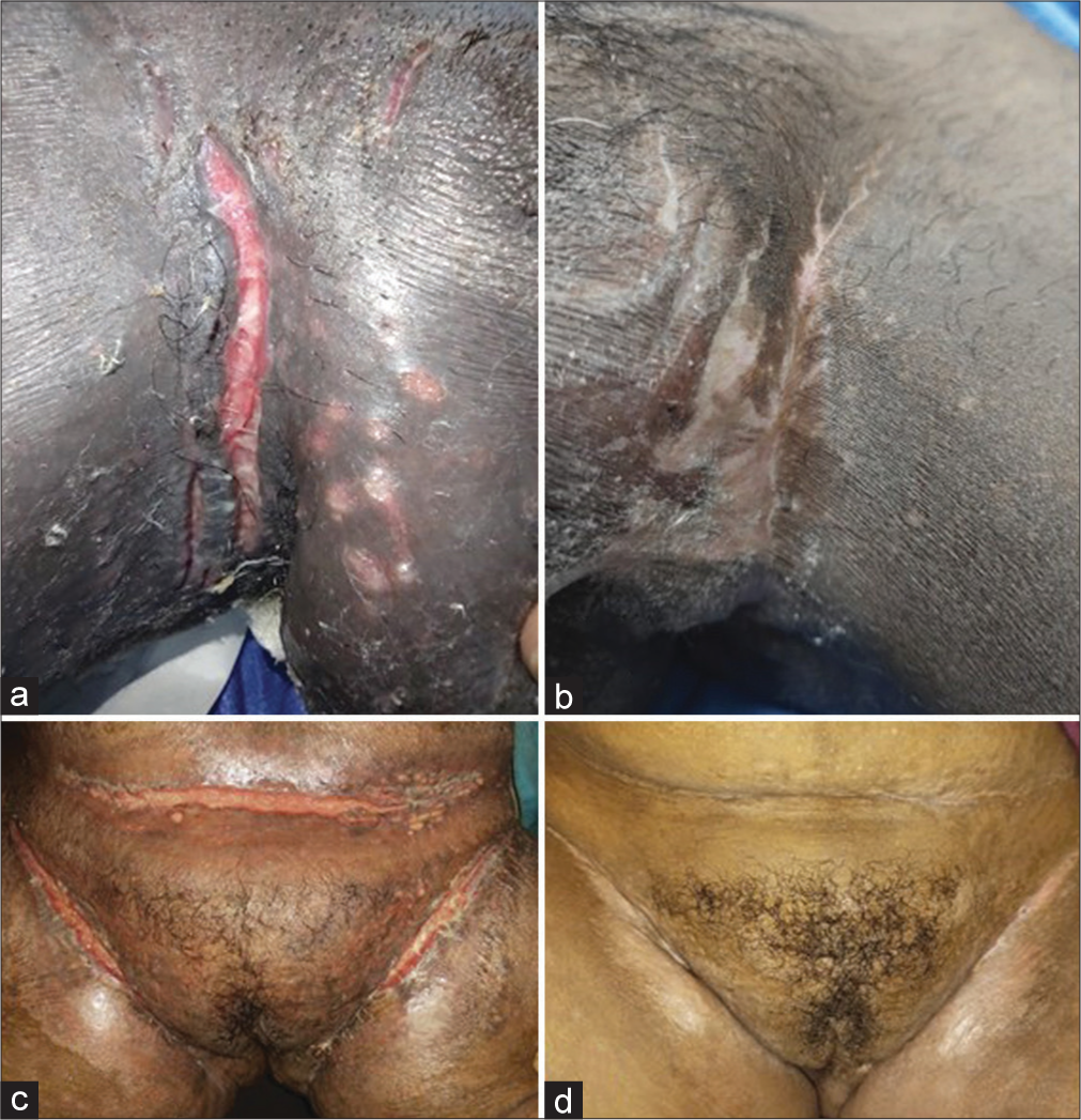 (a) Knife-cut ulcer in groin fold. (b) Complete healing of ulcer after weekly sessions of platelet-rich fibrin (PRF) after 4 weeks. (c) Knife-cut ulcer in suprapubic region. (d) Complete healing seen after weekly PRF after 3 weeks.