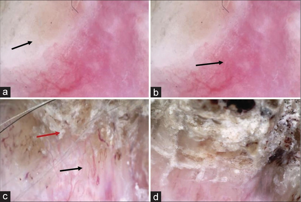 (a) Dermoscopy of horn base showing structureless white areas (black arrow), (b) erythema (black arrow), (c)arborizing vessels (black arrow), and scaling (red arrow). (d) Dermoscopy of lateral surface of horn with absence of terrace pattern. (DermLite DL3, 10×, polarized).