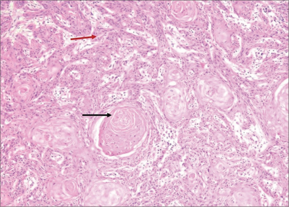 Histopathology showing well-delineated nests of tumor cells infiltrating the whole dermis with multiple keratin pearls (black arrow). The squamous cells are polyhedral with vesicular nucleus, abundant eosinophilic cytoplasm, and prominent intercellular bridges (red arrow) (H&E, 100×). H&E = hematoxylin and eosin.