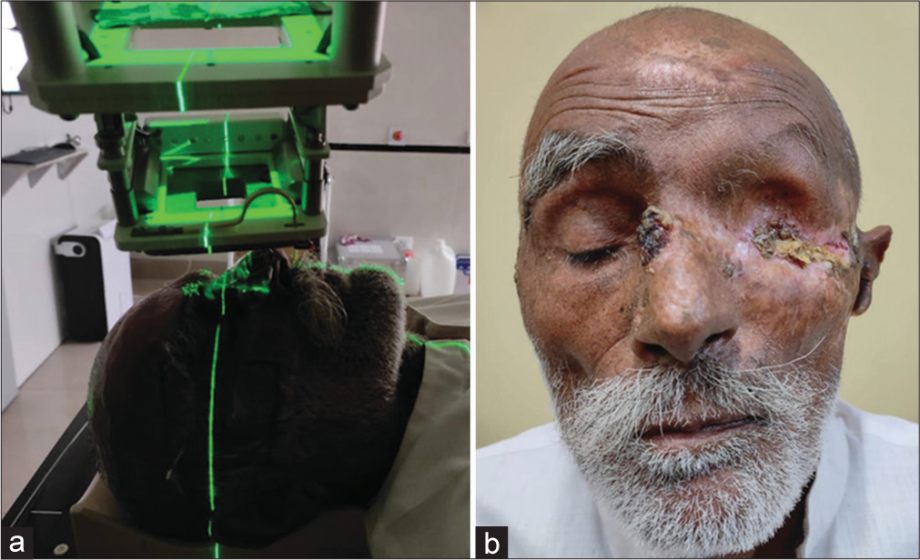 (a) Treatment of basal cell carcinoma (BCC) with electron beam radiotherapy. (b) Depigmented atrophic scar extending from medial canthus to preauricular region and one crusted ulcer of size 0.5X1 cm over dorsum of nose and yellowish crusting over lateral canthus.