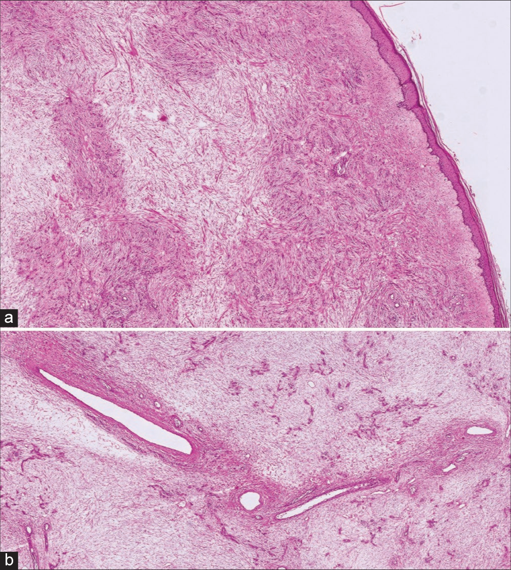 Histopathological examination (a) H&E ×40, (b) H&E ×80. Polypoid superficial paucicellular tumor with spindle cells in a myxoid loose matrix associated with blood vessels of variable size. H&E: Hematoxylin and eosin.