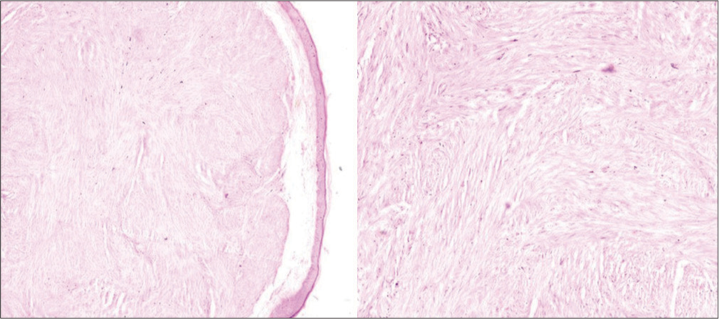 Neoplastic cells with features of smooth muscles seen in the reticular dermis in the section of biopsy specimen (hematoxylin and eosin stain; 100×).