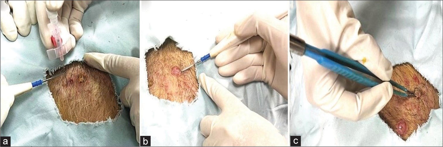 (a) Intralesional radiofrequency ablation with 20G cannula. (b) Tunnels on the wall of the lesion made with monopolar radiofrequency probe. (c) Two poles of the bipolar probe inserted into two adjacent tunnels at a time.