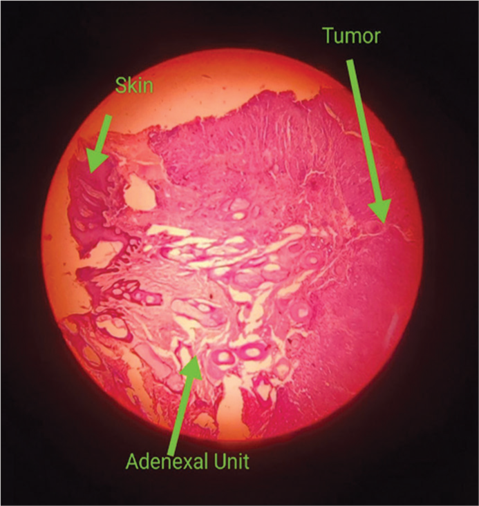 Histopathological image showing skin adnexal unit and tumor.