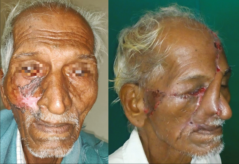 Extensive BCC of right cheek unit bordering up to right alar and upper-lip subunit in a 60-year-old man (A), resurfaced with a combination of cheek transposition flap and midline forehead flap (B). Division of forehead flap was carried out later