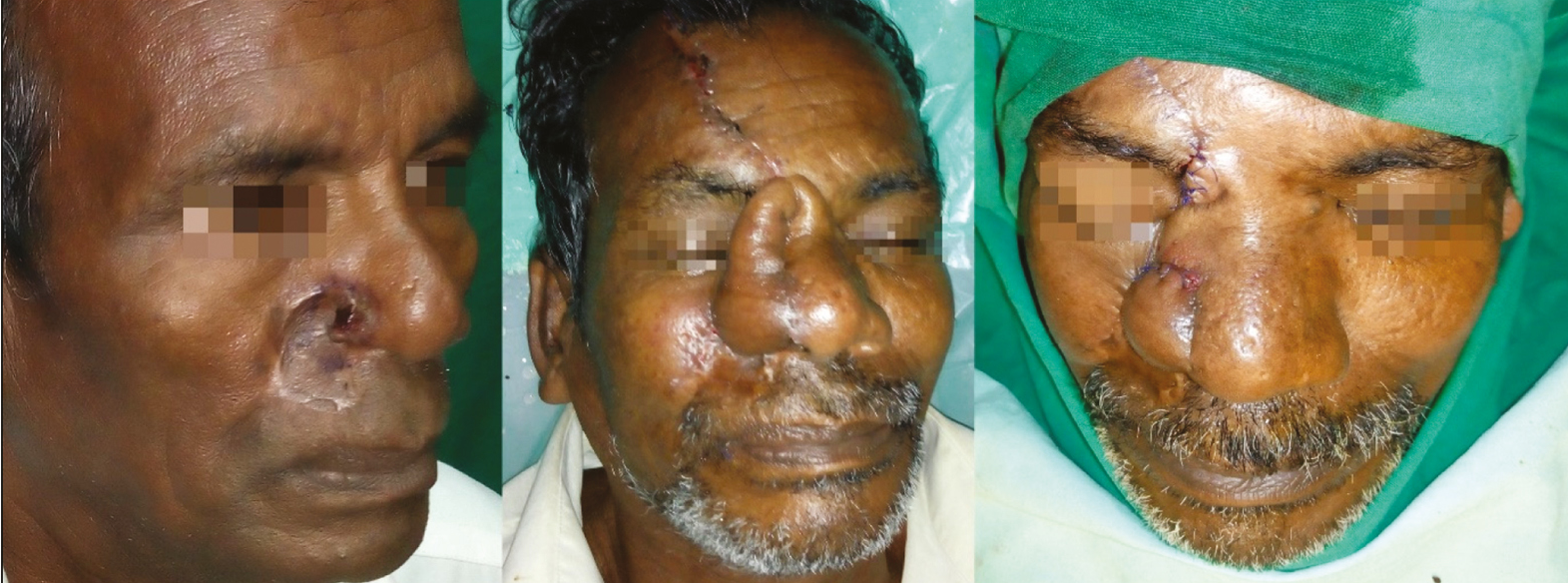 Recurrent BCC in a 55-year-old man involving right alar and upper lip subunit, excised and resurfaced with midline forehead flap