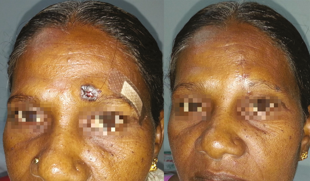 Pigmented BCC over forehead lower central subunit in a 58-year-old woman managed by elliptical excision and primary closure