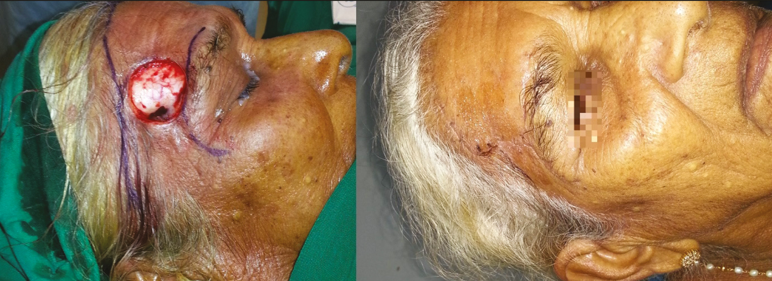 Defect following excision of BCC on lateral forehead subunit in a 65-year-old woman closed with bilateral advancement flaps