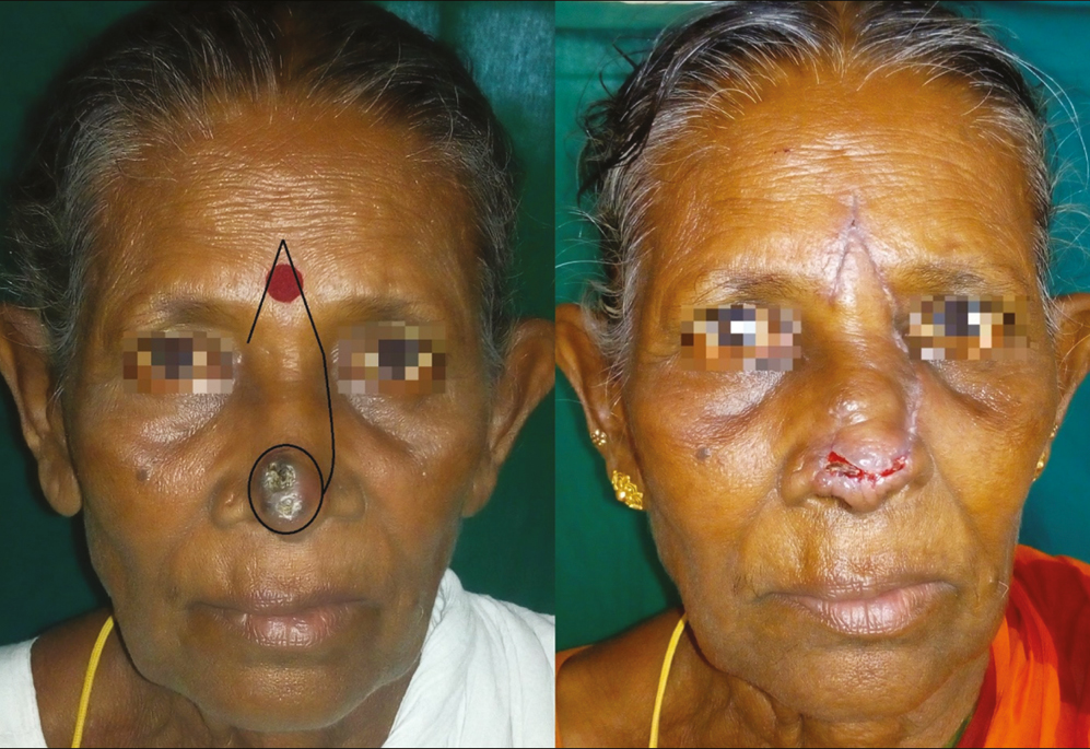 BCC involving nasal tip subunit in a 60-year-old woman resurfaced with an apron flap