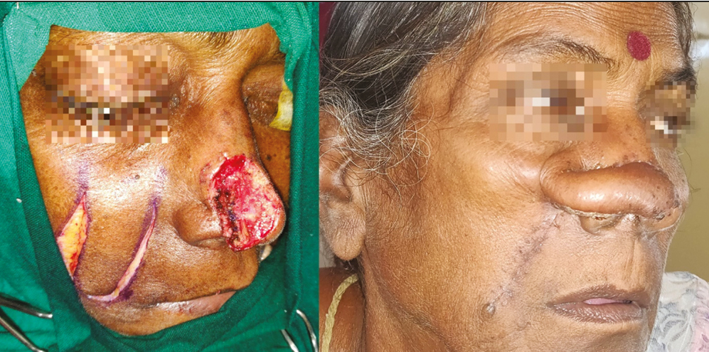 BCC post-excisional defect involving nasal tip, supratip, and right nasal wall subunit in a 50-year-old woman resurfaced with ipsilateral superior based nasolabial flap. Flap division and inset was done at a later date