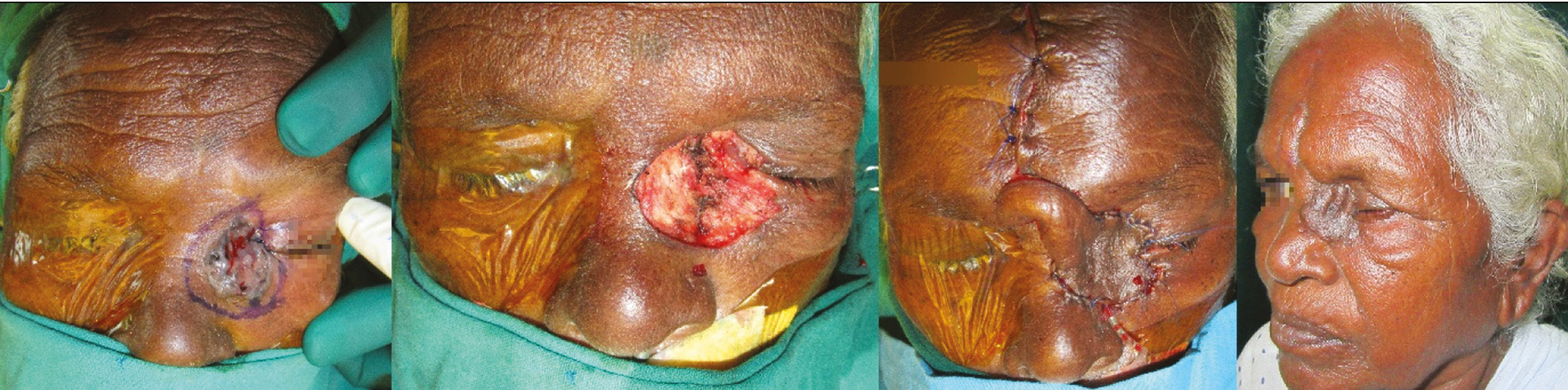 Extensive post-excisional defect of the left medial upper eyelid, canthus, lower eyelid, and lateral nasal wall in a 65-year-old woman resurfaced with a midline forehead flap. Division of the forehead flap was carried out at a later date