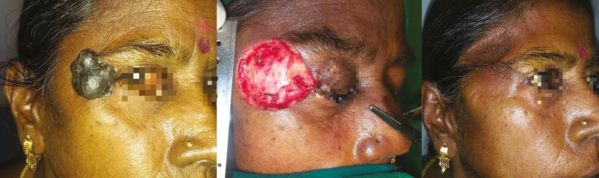 Extensive post-excisional defect of right lateral upper lid, canthus, lower lid and upper cheek subunit in a 50-year-old woman resurfaced with a lateral forehead flap