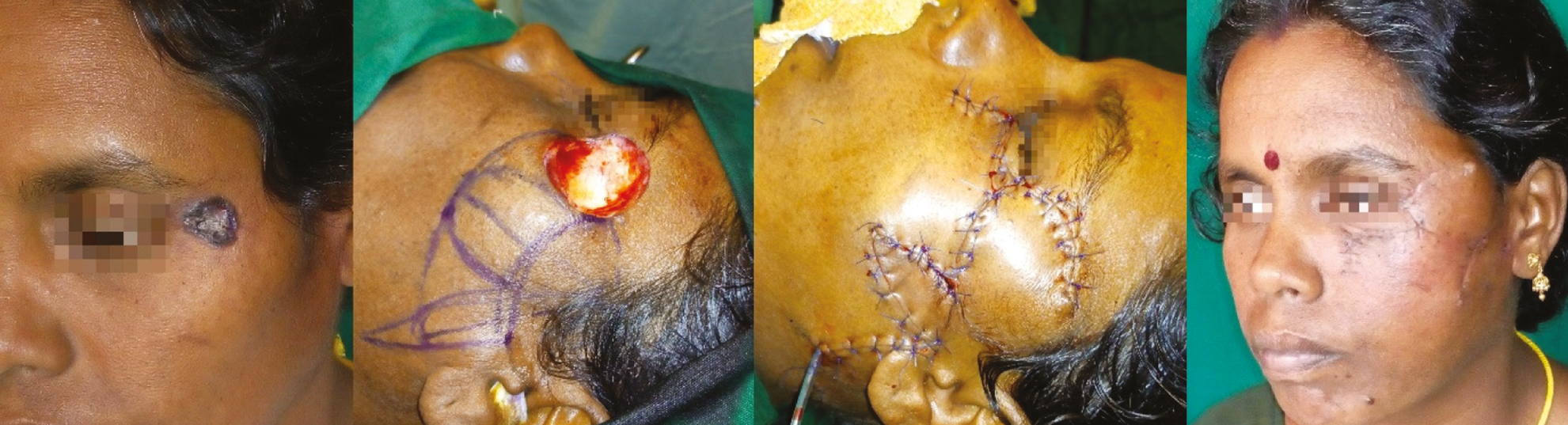 Smaller post-excisional defect of left lateral canthus and upper cheek subunit in a 45-year-old woman resurfaced with a pre-auricular based bilobed flap