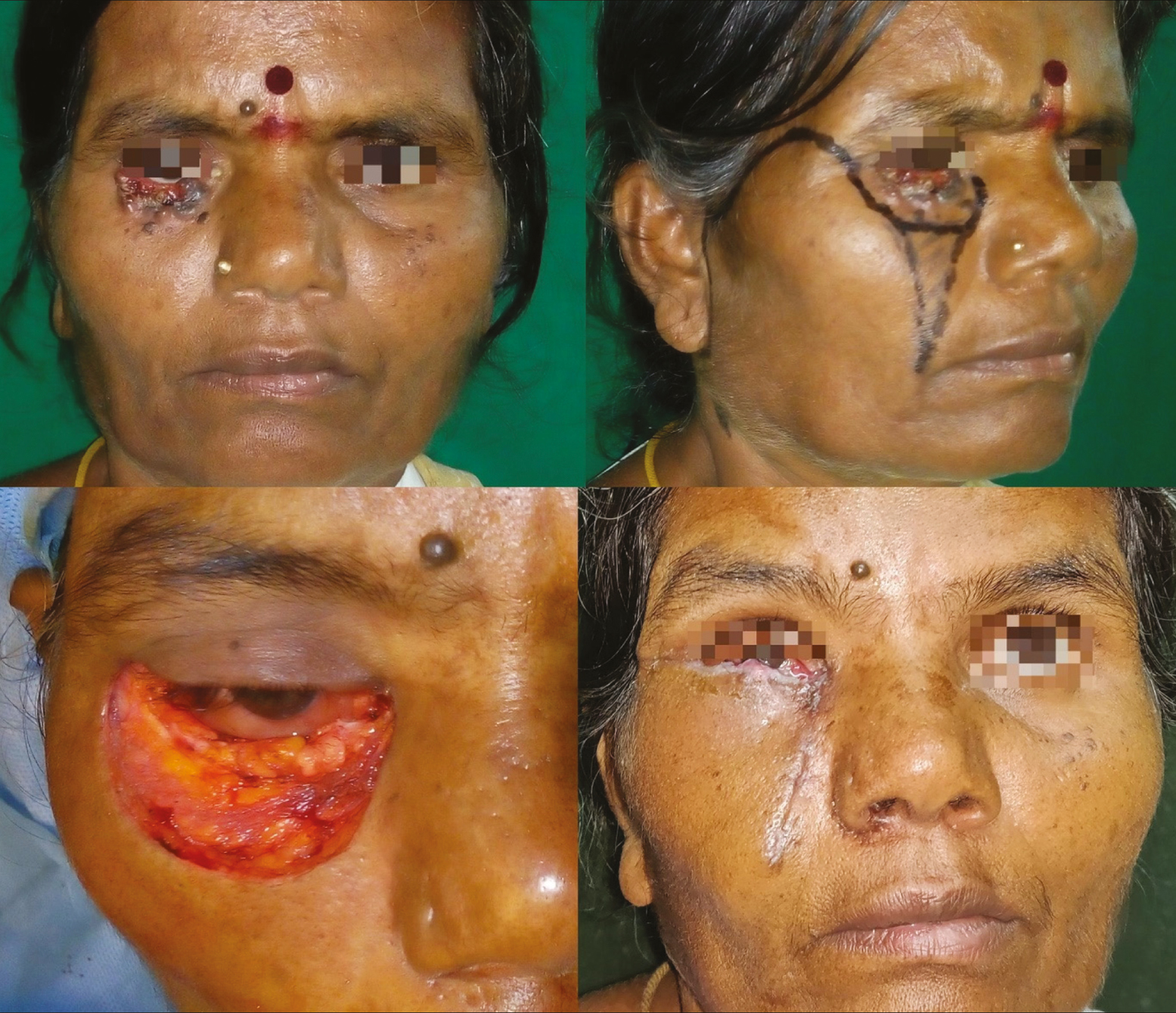 Extensive post-excisional defect involving right lower eyelid and cheek subunit in a 48-year-old woman resurfaced with a mustarde cheek advancement flap