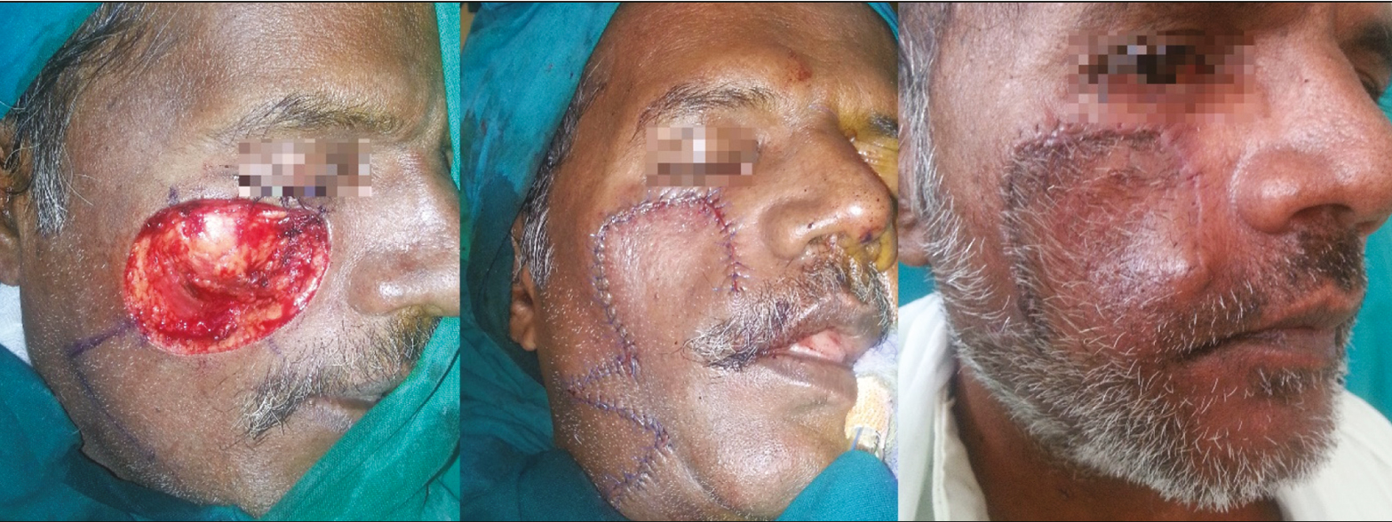 Extensive defect of right cheek suborbital subunit in a 55-year-old man, managed with medially based cheek transposition flap. This flap is less preferable in men due to the possibility of transposition of facial hair to suborbital regions