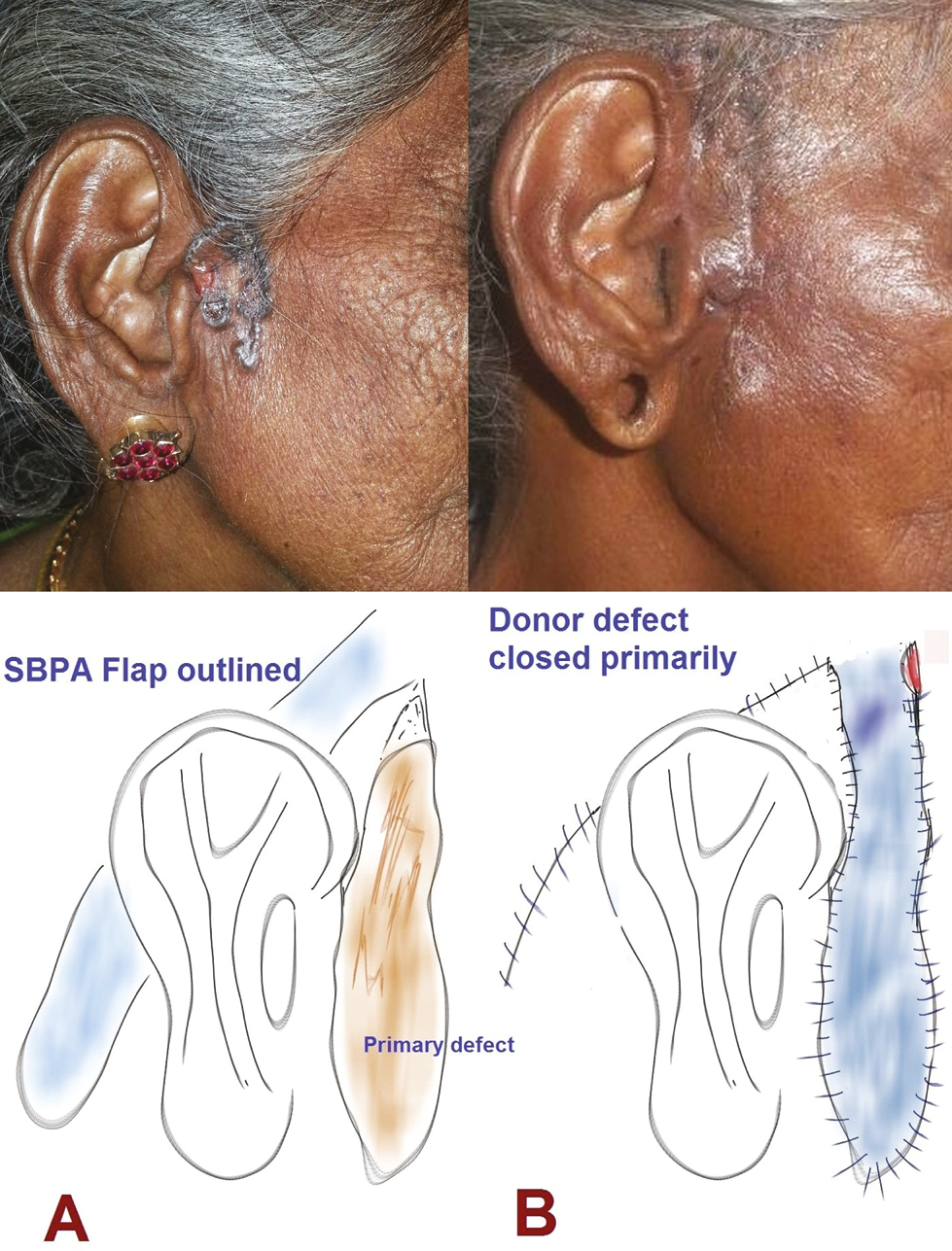 Lesion of preauricular subunit excised and resurfaced in a 60-year-old woman with a superiorly based post-auricular flap