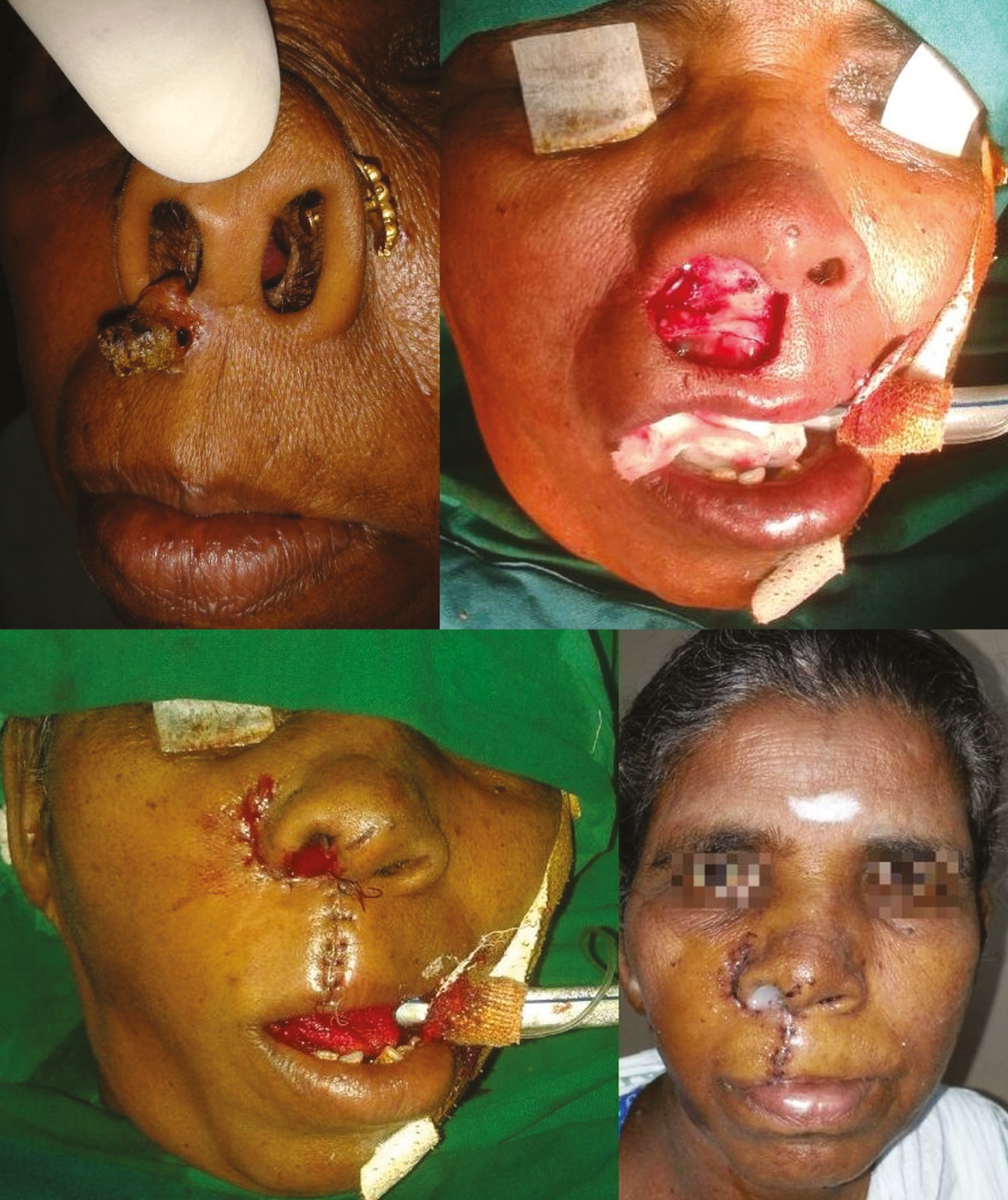 Post-excisional defect of the central upper lip and adjacent nasal rim in a 55-year-old woman resurfaced with lateral lip advancement