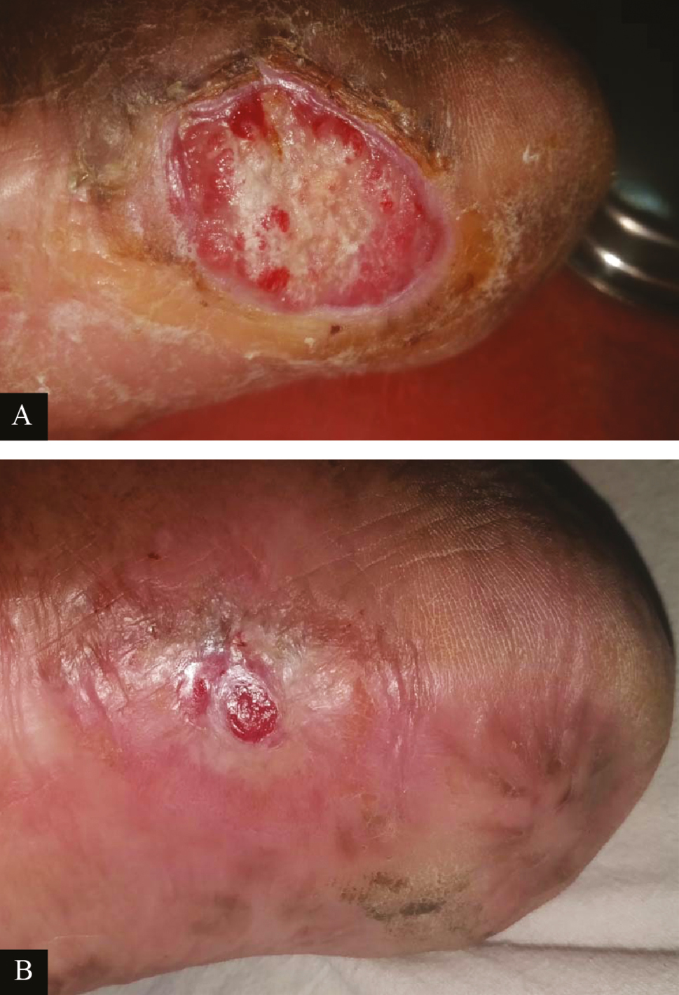 Clinical picture of platelet-rich fibrin dressings in ulcer due to Hansen’s disease: (A) at baseline (B) after sixth platelet-rich fibrin dressing (re-epithelized)