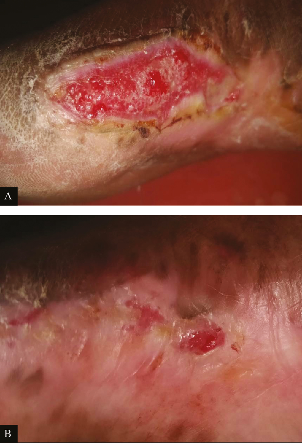 Clinical picture of PRP dressing in ulcer due to Hansen’s disease: (A) at baseline (B) after fourth PRP dressing