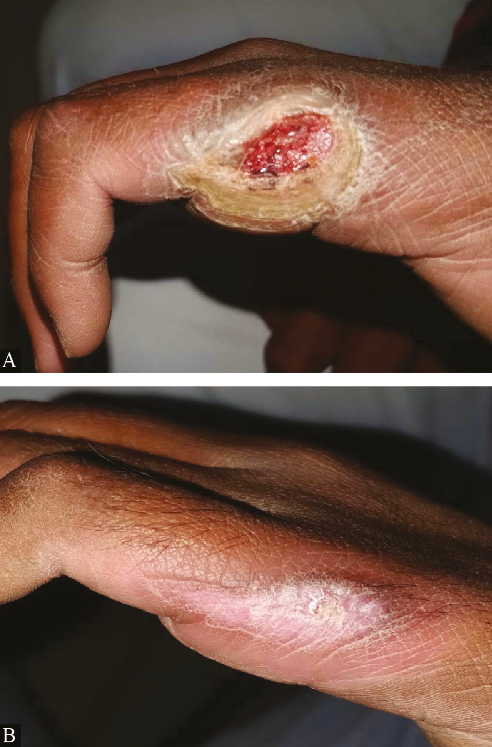 Clinical picture of platelet-rich fibrin dressings in ulcer due to Hansen’s disease: (A) at baseline (B) after third platelet-rich fibrin dressing (re-epithelized)