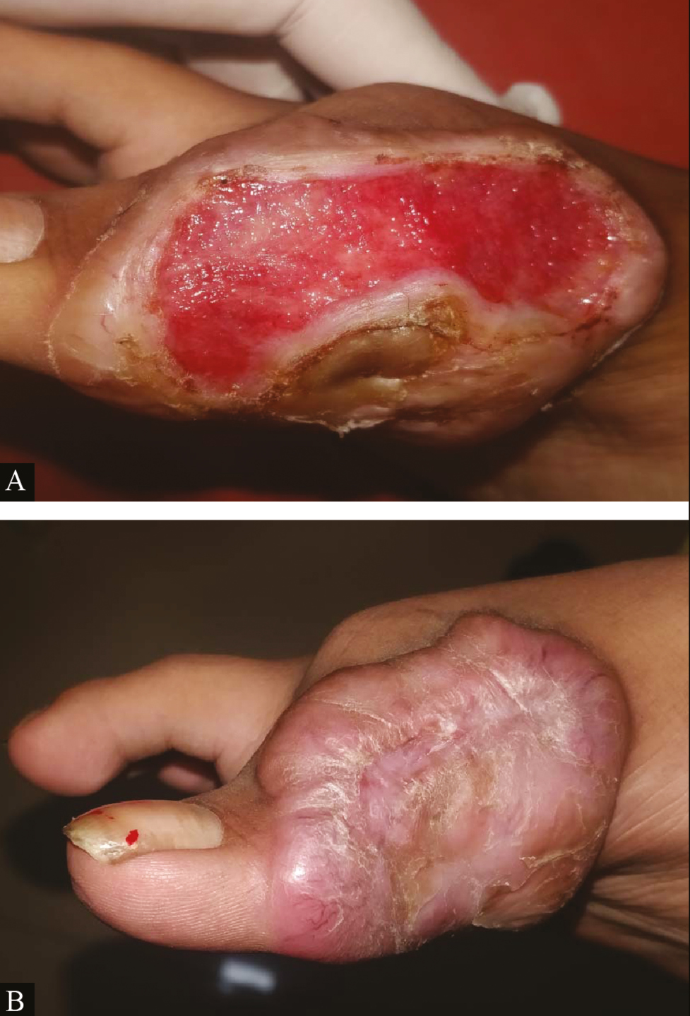 Clinical picture of platelet-rich fibrin dressing in ulcer due to keloid with chronic ulcer: (A) at baseline (B) after fourth platelet-rich fibrin dressing