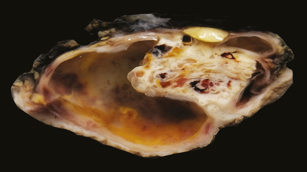 Gross of nodular hidradenoma showing solid and cystic swelling