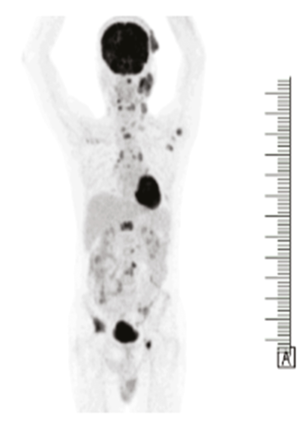 Case 1 FDG avid PET lesion in scalp