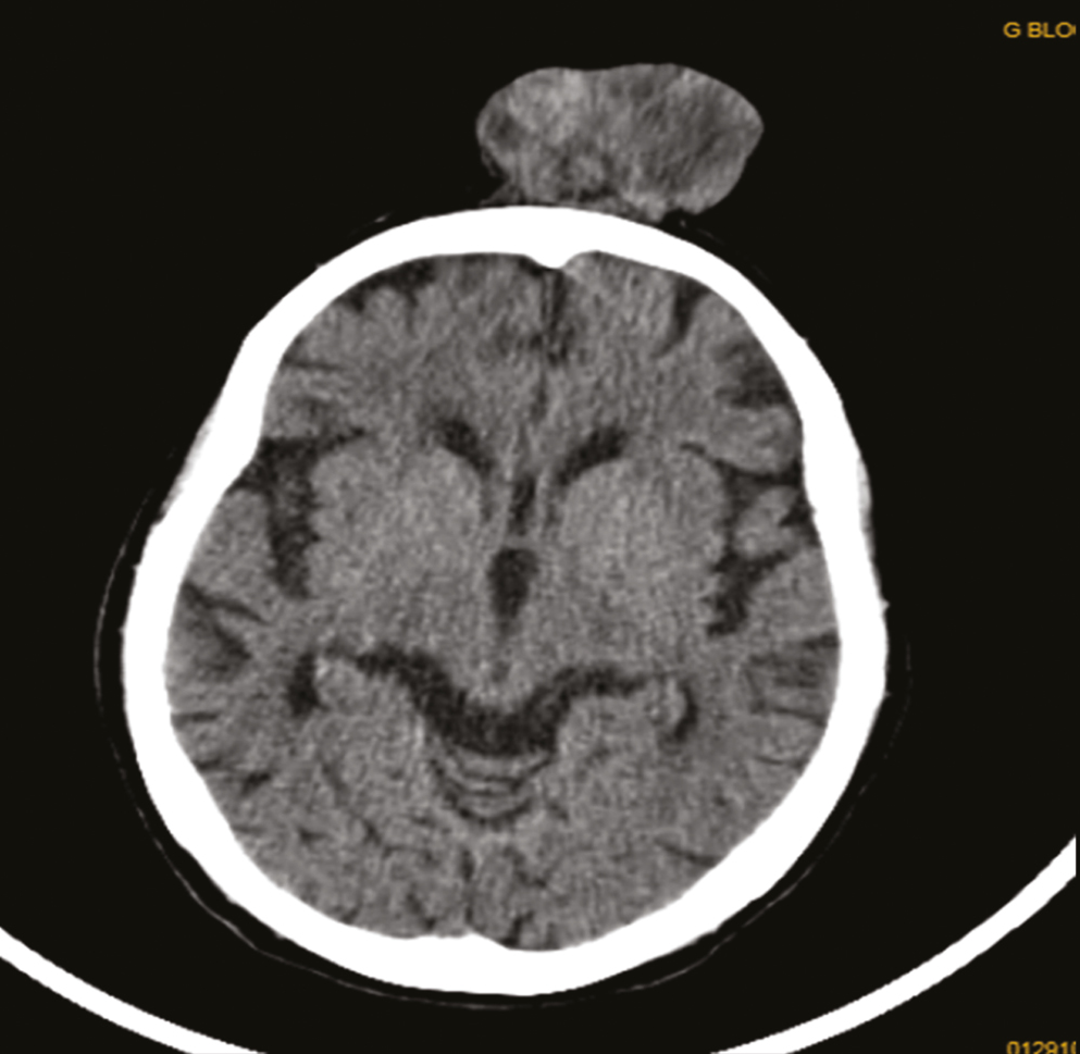 Case 2 CT scan of scalp lesion