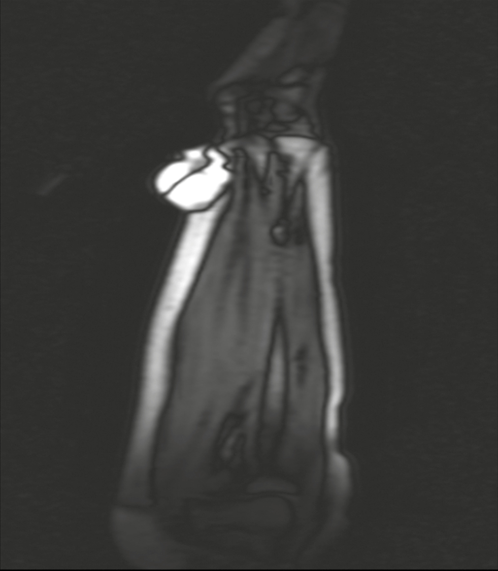 Case 3 MRI of soft tissue swelling of forearm